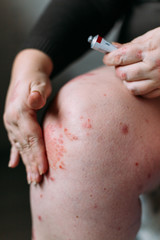 applying an emollient to dry flaky skin as in the treatment of psoriasis, eczema and other dry skin...