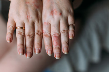The problem with many people - eczema on hand. Woman's hands