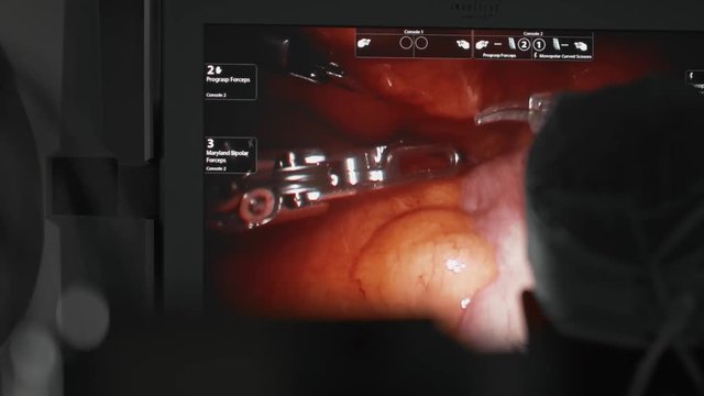 Medical surgical robot, cancerous tumor removal surgery. surgeon looks at screen showing internal organs. Modern medical equipment. Minimally Invasive Robotic Surgery with the Da Vinci Surgical System