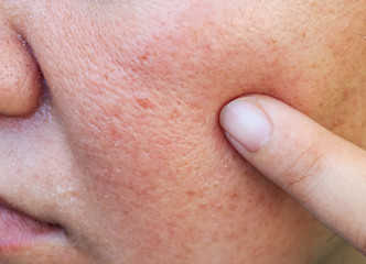 Close-up of acne on the skin, Acne on the face caused by Hormone, The scars, wrinkle and acne inflammation on the face skin