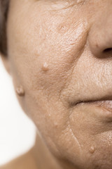 Naklejka premium Elderly pensioner female, dermal fibroma closeup.