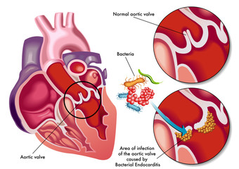 vector medical illustration of the symptoms of bacterial endocarditis