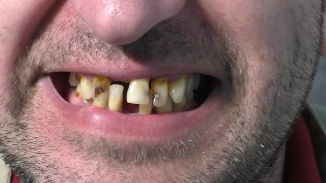 Bad teeth, mouth, unhealthy, horror. Missed teeth