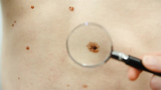 Checking skin mole with a magnifying glass 4K