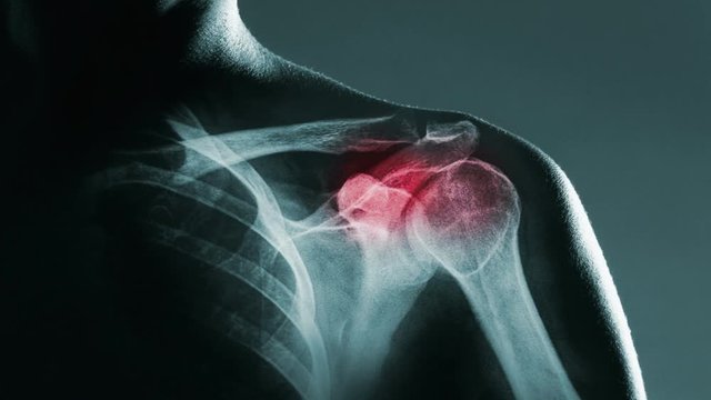 Human shoulder joint in x-ray with screen ripple and noise for electronic displays of medical equipment or pc tablet. The shoulder joint is highlighted by red colour.