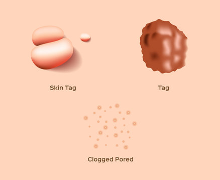 Skin Tag And Clogged Pored Vector