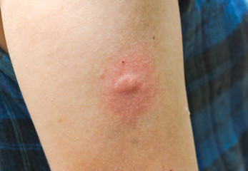 Fototapeta premium Allergic reaction to mosquito bites