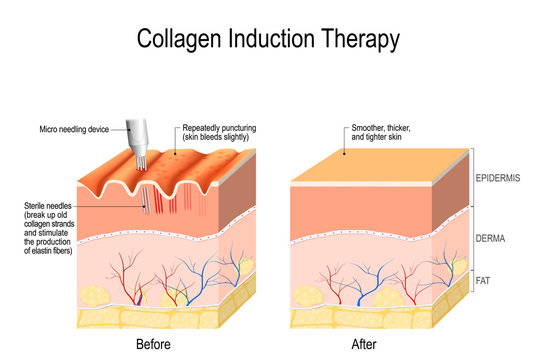 Collagen Induction Therapy. Microneedling The Skin