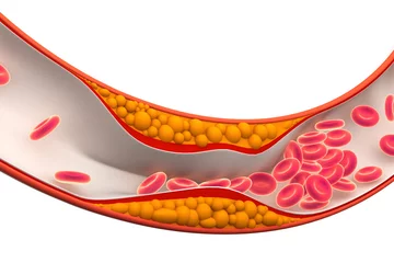 Deurstickers Cholesterol plaque in artery.3d render © Crystal light