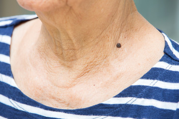 Black mole on senior woman's neck, Medicine, Close up