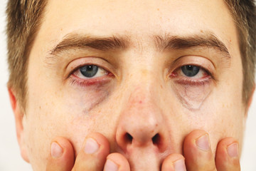 Conjunctivitis, tired eyes, red eyes, eye disease
