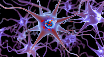 Parkinson's disease. 3D illustration showing neurons containing Lewy bodies small red spheres which are deposits of proteins (alpha-synuclein) accumulated in the brain cells.