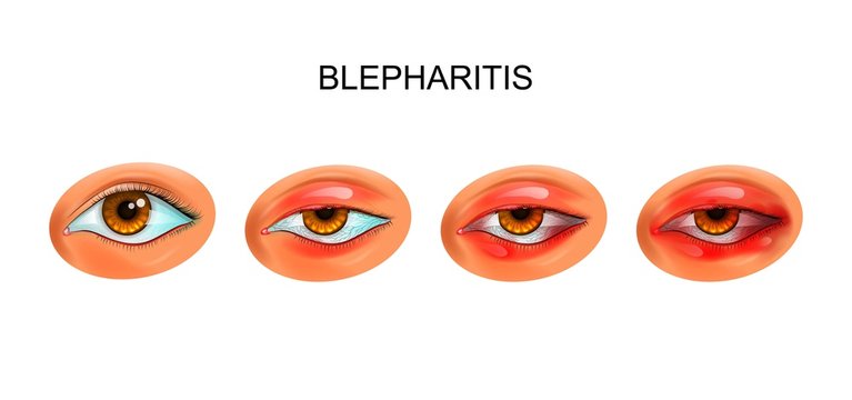 inflammation of the eyelids. blepharitis