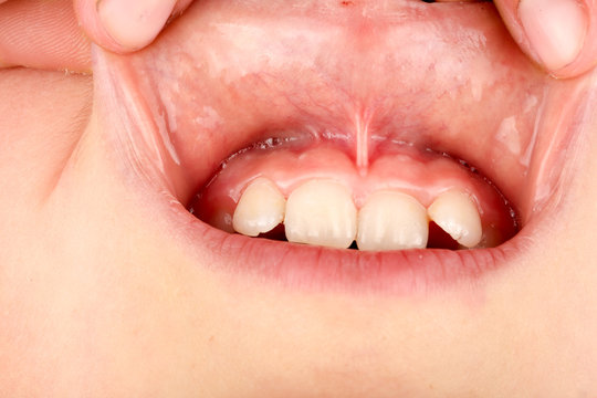 the bridle of the upper lip in the child close up