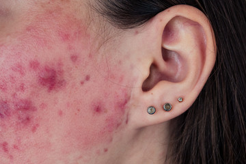 pimples on a girl's skin closeup