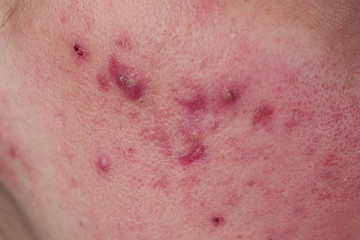 acne on the skin close up