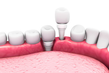 Dental implant structure - obrazy, fototapety, plakaty