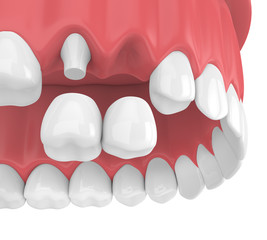 3d render of dental cantilever bridge with crowns in upper jaw