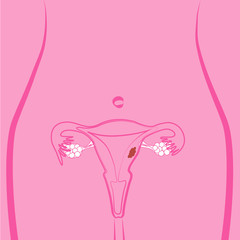 Uterine Fibroid vector illustration