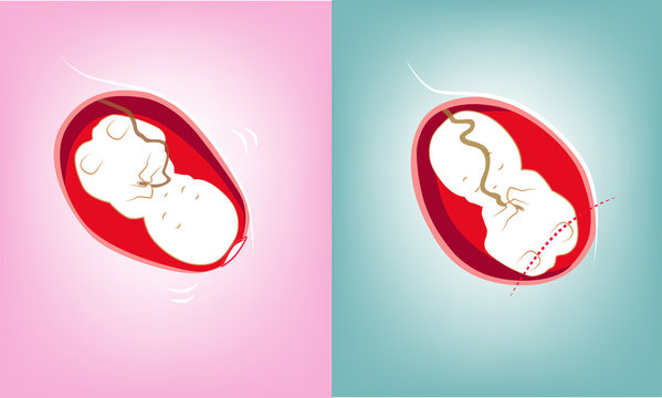 Nature born and Cesarean section Stock Vector | Adobe Stock