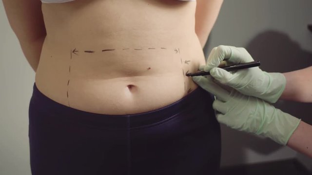 Doctor marking fat zones on girl abdomen. Overweight concept.
