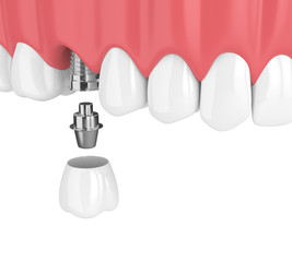 3d render of upper jaw with teeth and dental molar implant © Aleksandra Gigowska
