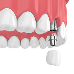 3d render of upper jaw with teeth and dental premolar implant
