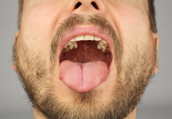 man with a beard opened his mouth for dental examination