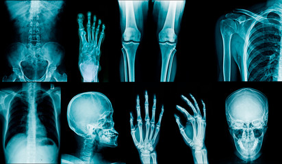 collection x-ray image skull, shoulder, hip, knee joint , scoliosis spinne and small joint in...