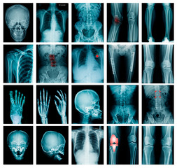 collection x-ray image skull, shoulder, hip, knee joint , scoliosis spinne and small joint in...