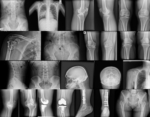 collection x-ray image knee, skull, chest, spine, pelvic, shoulder, fracture leg with fixation