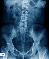 x-ray lumbar spine show degenerative change of disc and body of spine