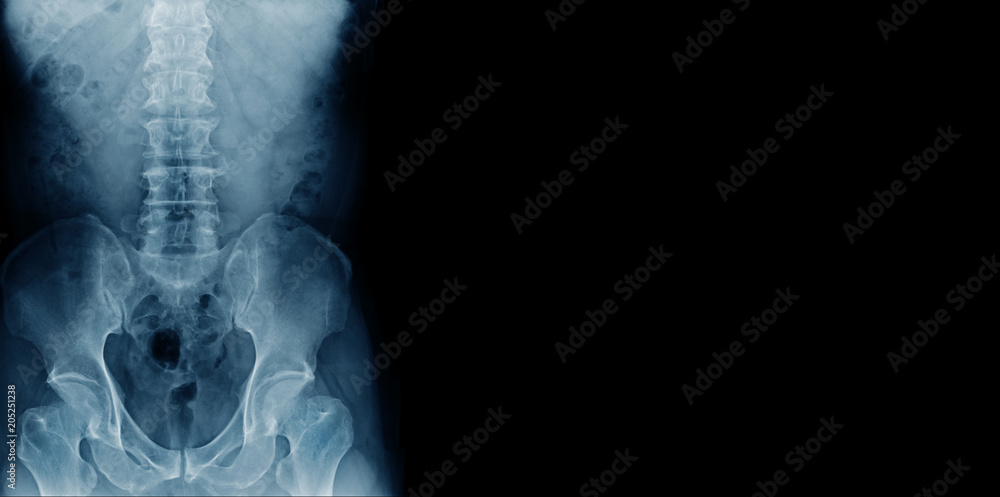 Sticker x-ray banner of lumbar spine with degenerative change and spur