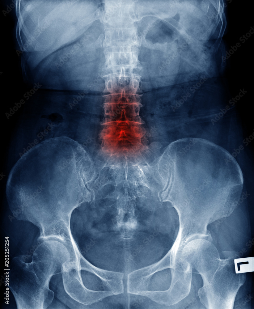 Sticker lumbar spondylosis with loss space of disc and bammboo spine