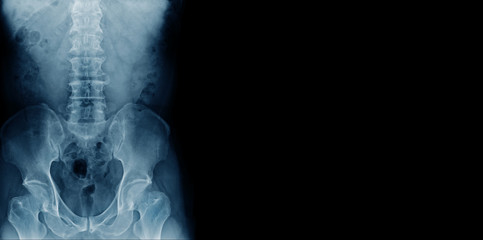 x-ray banner of lumbar spine with degenerative change and spur