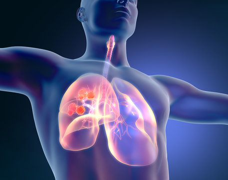 Lung cancer, medical illustration