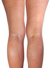 Woman legs with varicose veins