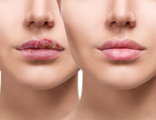 Female lips with herpes sore before and after treatment. - obrazy, fototapety, plakaty
