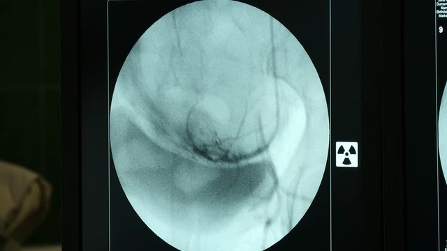 A wonderful view of a woman`s breast with black arteries and veins twinking on a circular monitor of an X-ray appliance.