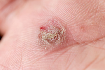 Atopic dermatitis (AD), also known as atopic eczema, is a type of inflammation of the skin (dermatitis).