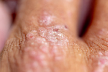 Atopic dermatitis (AD), also known as atopic eczema, is a type of inflammation of the skin (dermatitis).