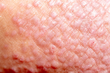 Atopic dermatitis (AD), also known as atopic eczema, is a type of inflammation of the skin (dermatitis). - obrazy, fototapety, plakaty