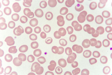 Target cells with abnormal red blood cells from anemia patient, analyze by microscope
