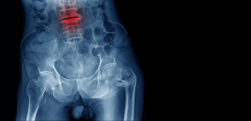 compression fracture lumbar L4-5, S1 level with loss space of disc
