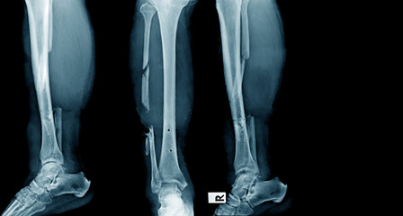 fracture of tibia and fibular bone