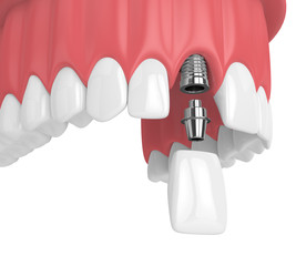 3d render of upper jaw with teeth and dental incisor implant © Aleksandra Gigowska