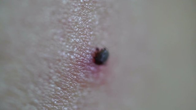 Tick Fastened to Human Skin Feeding on Blood
