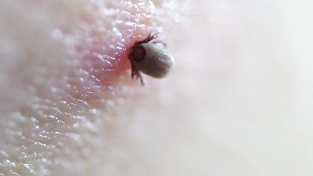 Tick Fastened to Human Skin Feeding on Blood