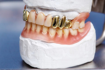 Dental gold teeth prosthesis, clay mold human gums model