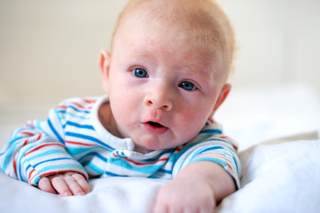 Allergies, atopic dermatitis on the face of a baby